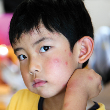 Kenali Cacar Air Pada Anak