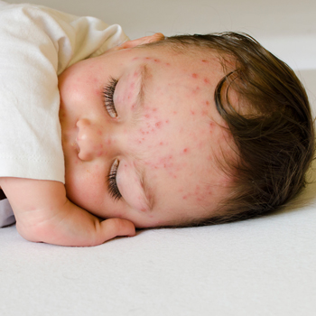 Hati-Hati Waspada Campak!