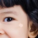 Bila Anak Mengalami Panu