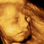 Janin Rentan Skizofrenia?