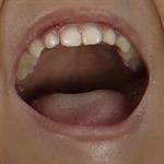 Amandel Bengkak Haruskah Dioperasi?