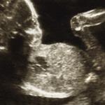 Janin Lambat Berkembang 