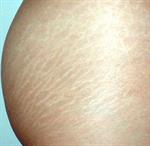 Usir Strech Marks